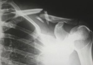 How a Slip and Fall Accident Can Ruin Your Life