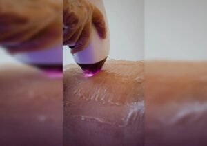 Removing Body Hair With a Laser