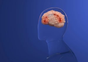Hypoxic and Anoxic Brain Injuries