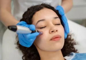 Benefits of Microneedling