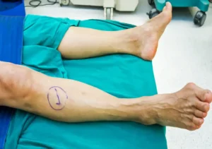 patient leg marked for surgery in hospital setting